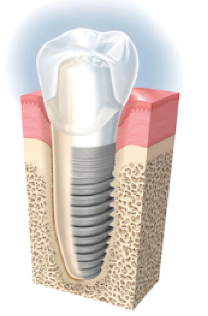 Clinica GO - Implante Dental