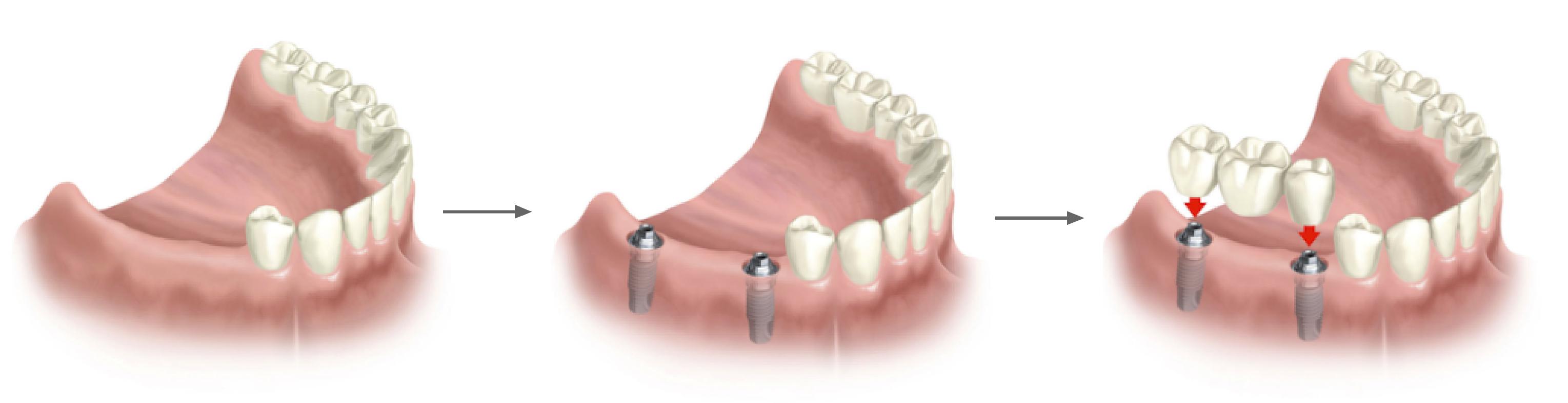 Clínica GO - Puente porcelana sobre implantes